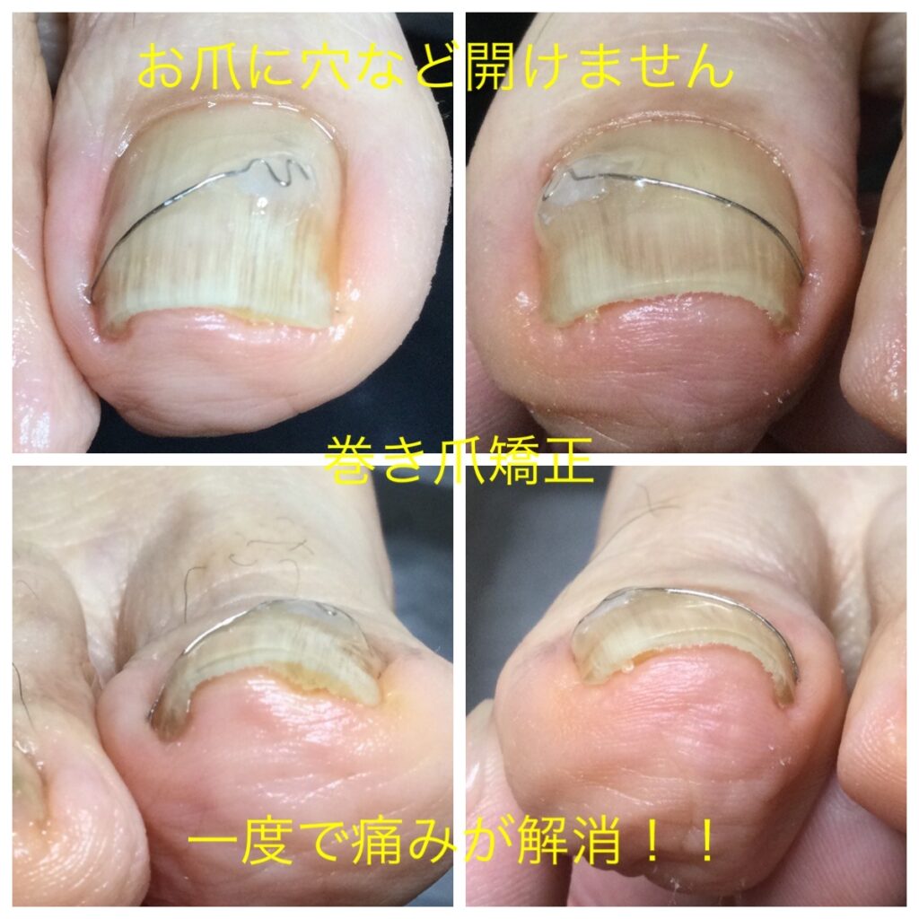 痛くなる前に巻き爪矯正を 用賀のネイル まつ毛エクステ ドクターネイル Cure プラスキュア 用賀店